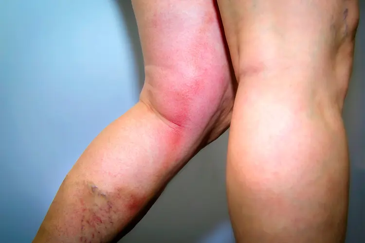 Treatment For Dvt In Leg